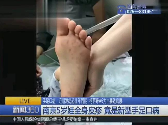                     新型手足口病爆发！症状“变异”易误诊，有这些特征的宝宝要当心了…