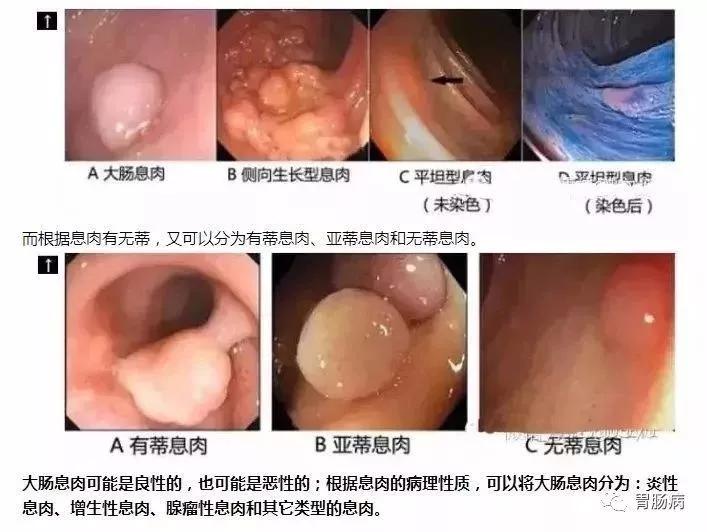 大肠是息肉的好发部位,由于很少引起症状,也很少引起出血和梗阻,因此