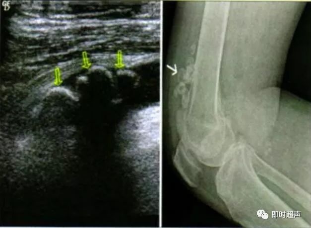 超声提示:左膝关节滑膜囊积液并游离体.考虑滑膜骨软骨瘤病(图 l 左).