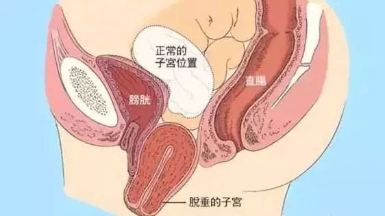 阴道里脱出块"肉",竟是这个器官!
