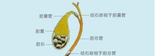 黄疸:部分胆囊结石患者可以出现一过性黄疸,多在剧烈腹痛之后,且黄疸