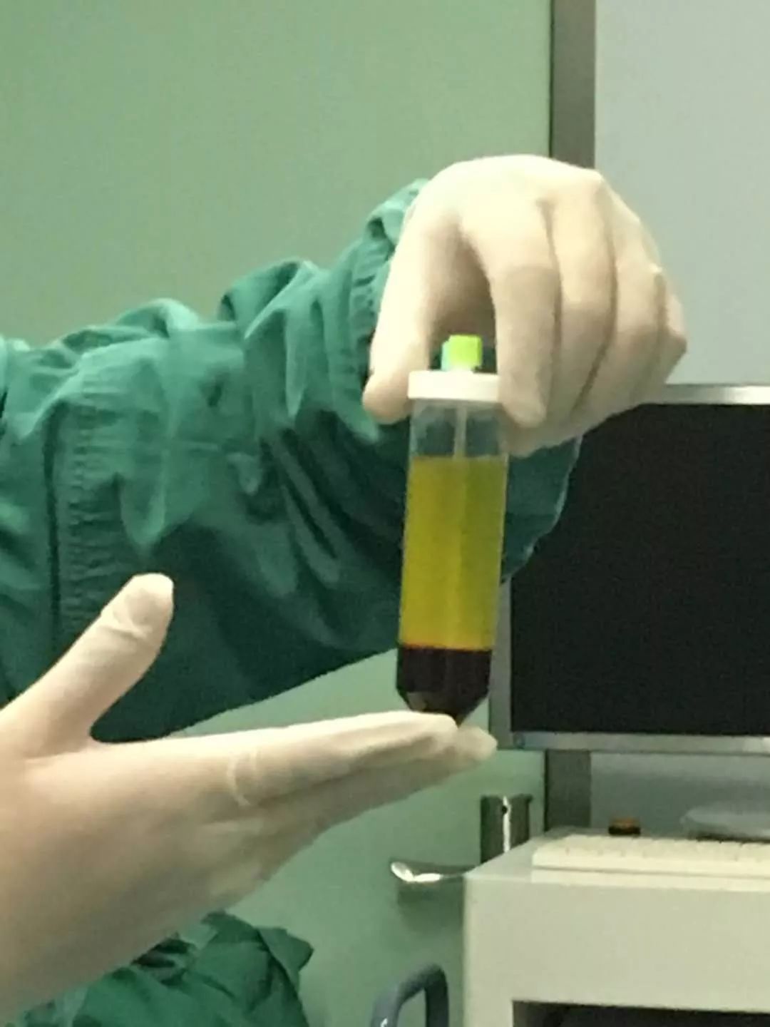 全称:富血小板血浆(platelet-rich plasma,prp,是自体全血经离心后