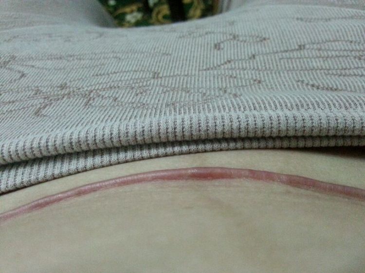                     产妇剖腹产后怎么做，才能缓解疼痛？两次剖腹产宝妈的办法很管用