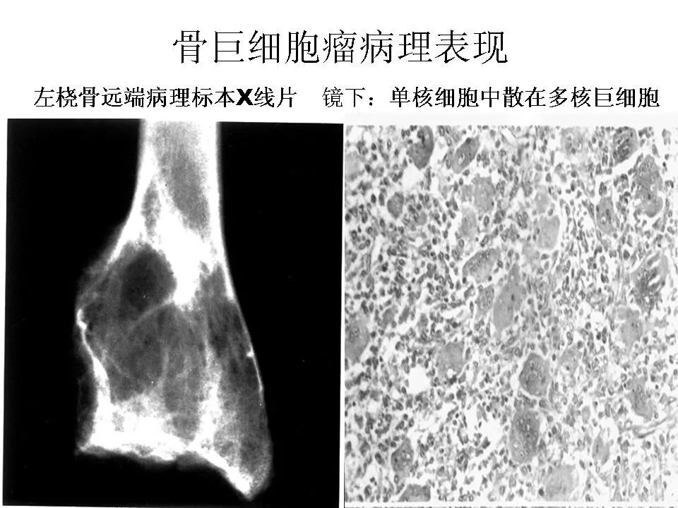 骨巨细胞瘤影像诊断及鉴别诊断 | 影像天地