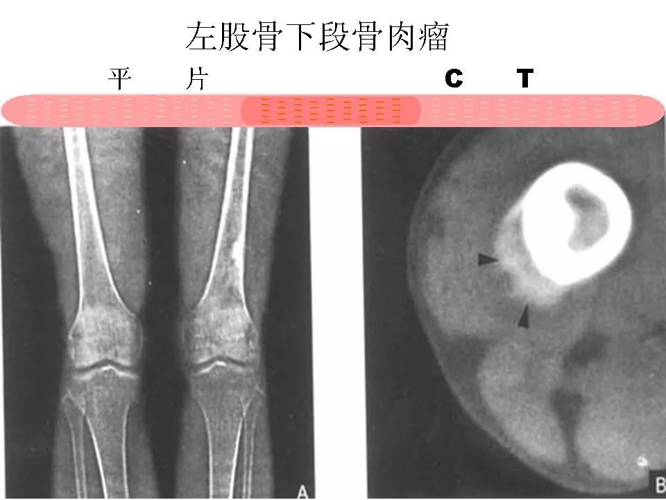 骨巨细胞瘤影像诊断及鉴别诊断影像天地