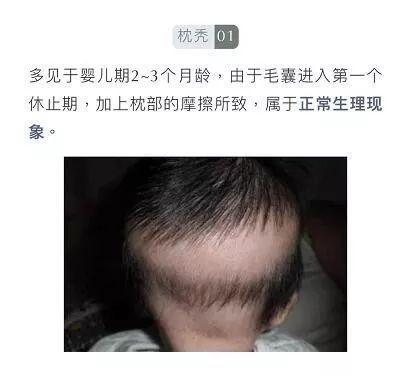                     “10后”也秃了？4岁女孩头发几乎掉光，原因竟和家里这个有关