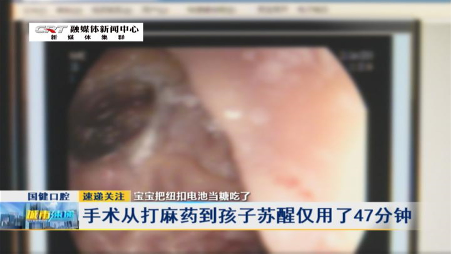                     7个月宝宝把纽扣电池当糖吃了 医生“化学物2小时能让胃溃疡，4小时穿孔……”