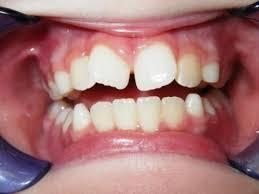 乳牙没掉牙齿长出来歪了 孩子牙齿长歪，儿童牙医：别管乳牙还是恒牙，这五个方法都适