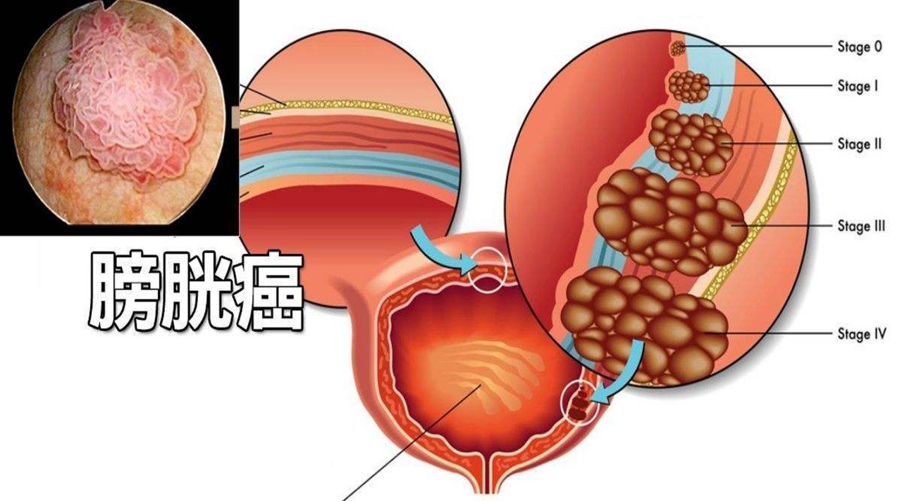 膀胱造瘘什么原理_膀胱造瘘图片(2)