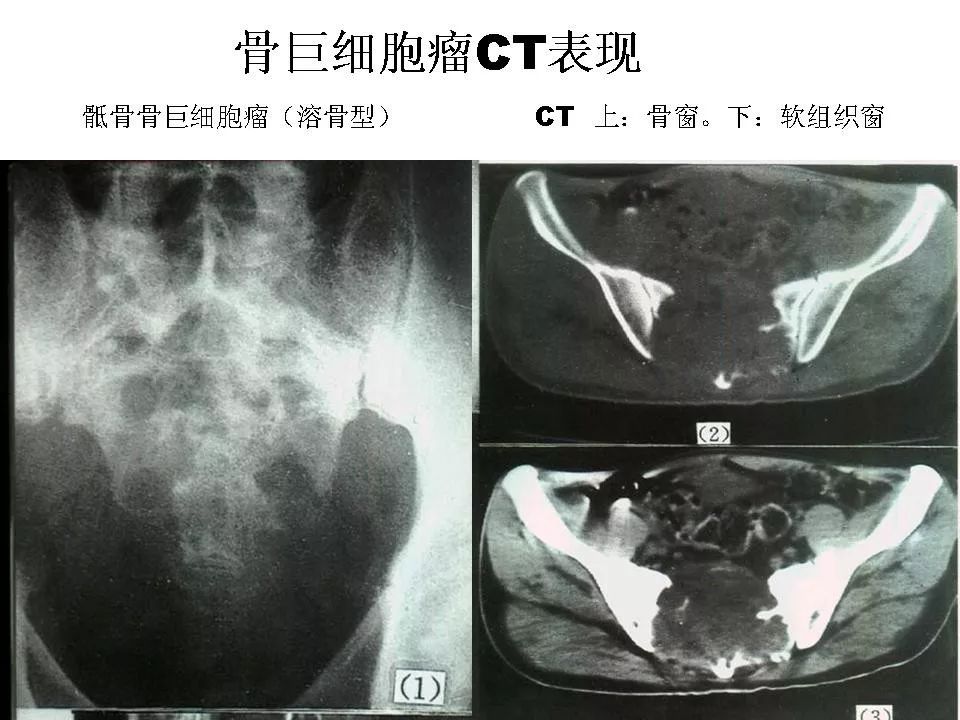 骨巨细胞瘤影像诊断及鉴别诊断影像天地