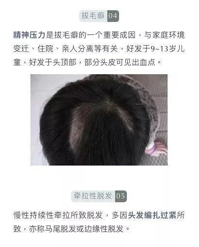                    “10后”也秃了？4岁女孩头发几乎掉光，原因竟和家里这个有关