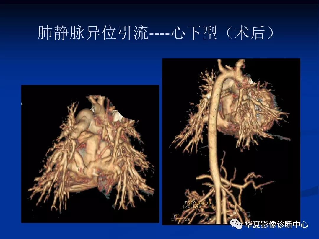 影像基础肺静脉畸形引流的影像诊断