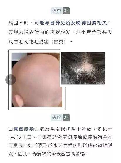                     “10后”也秃了？4岁女孩头发几乎掉光，原因竟和家里这个有关