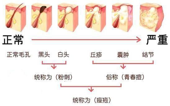 化妆痘痘闭口粉刺的区别