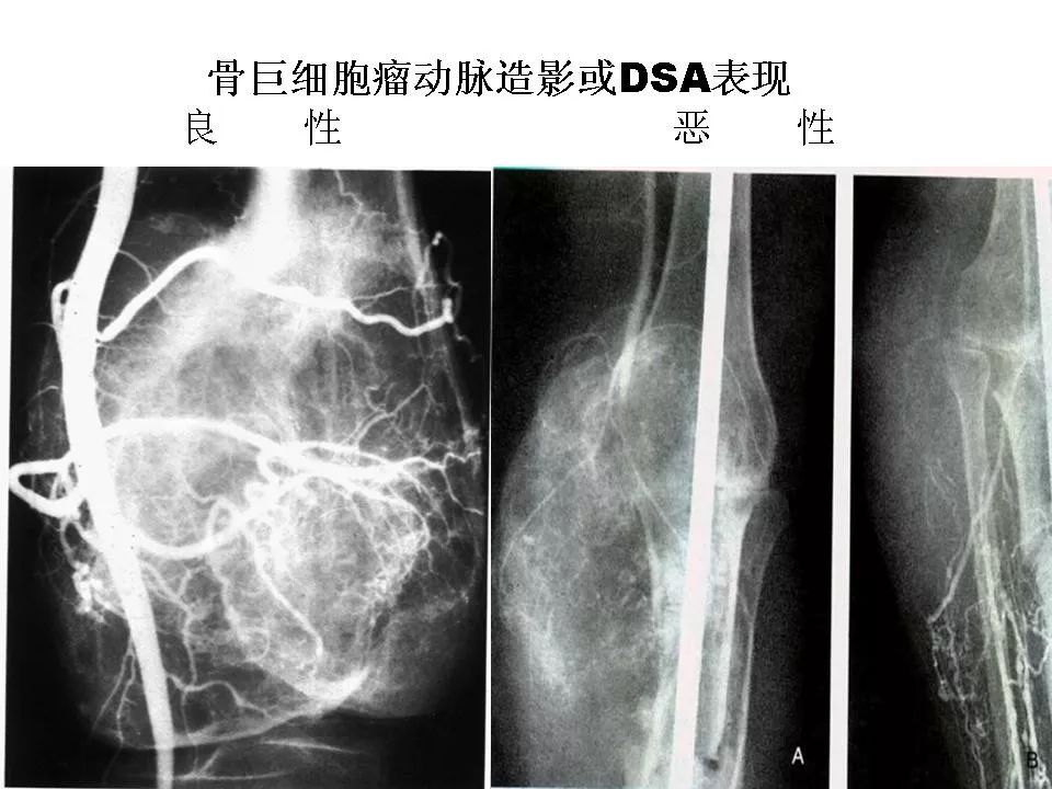 骨巨细胞瘤影像诊断及鉴别诊断影像天地