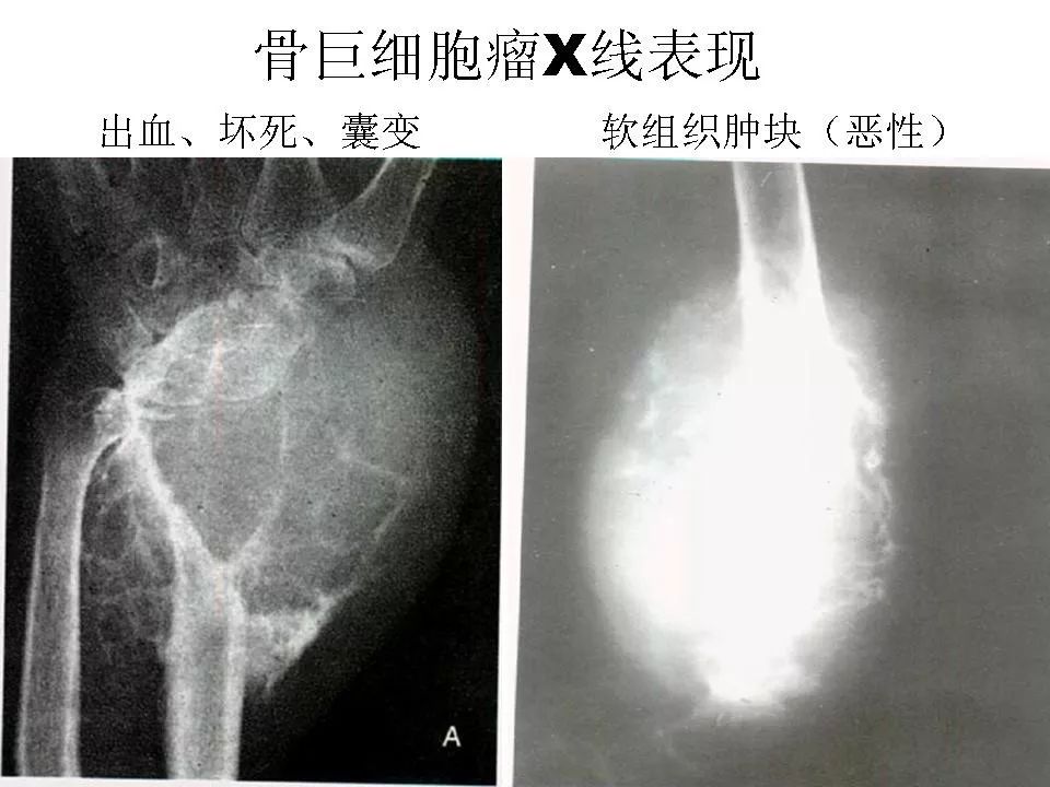 骨巨细胞瘤影像诊断及鉴别诊断影像天地