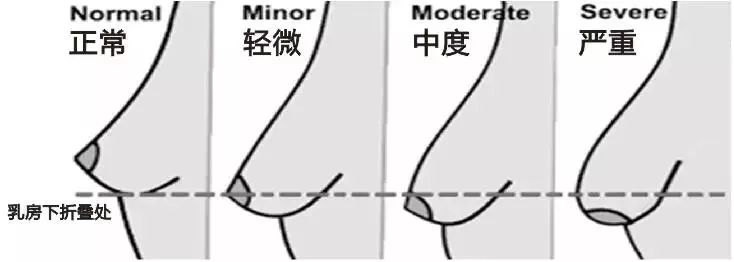 年龄越大,胸越容易下垂,这是由3个原因导致的: 1)年轻女性的乳房里