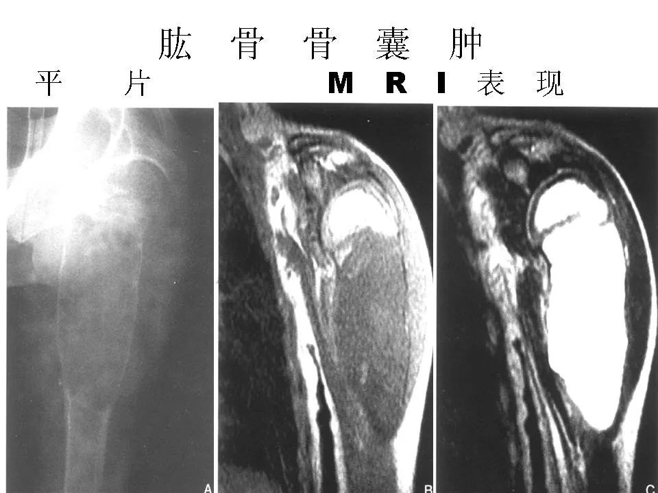 骨巨细胞瘤影像诊断及鉴别诊断影像天地