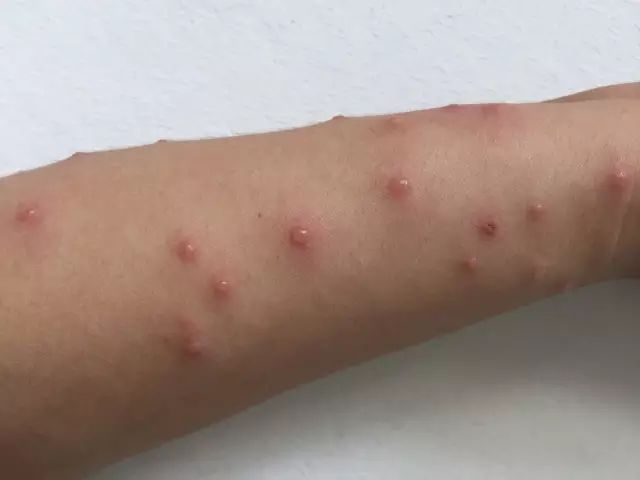 【保健】做好这几点,才能正确预防蚊虫咬!
