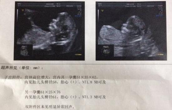 怀孕13周产检时医生说是双胞胎，一个月后一个胎儿不翼而飞，怎么回事？ 双胞胎产检项目