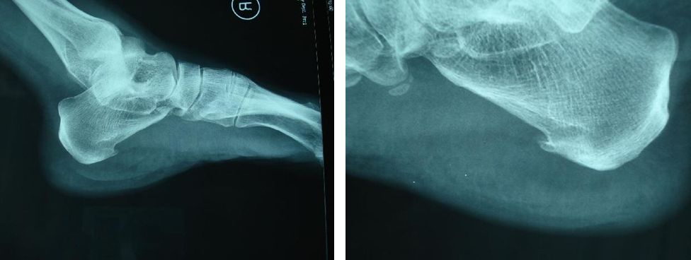 辅助检查 1,x-ray 跟骨侧位或轴位:摄片视跟骨局部情况,骨刺的有无