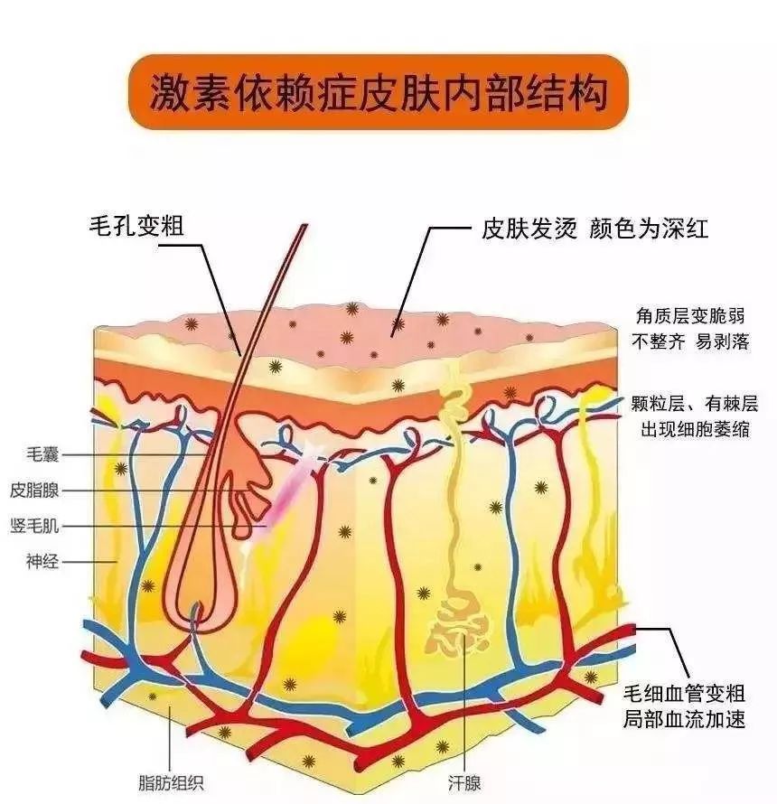 七老护肤科普：修复激素依赖性皮炎的四个阶段