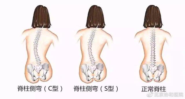 青少年特发性脊柱侧凸_青少年特发性脊柱侧凸重要致病机制被锁定