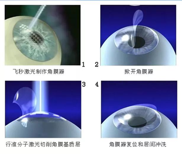 全飞秒近视手术的原理_全飞秒(2)