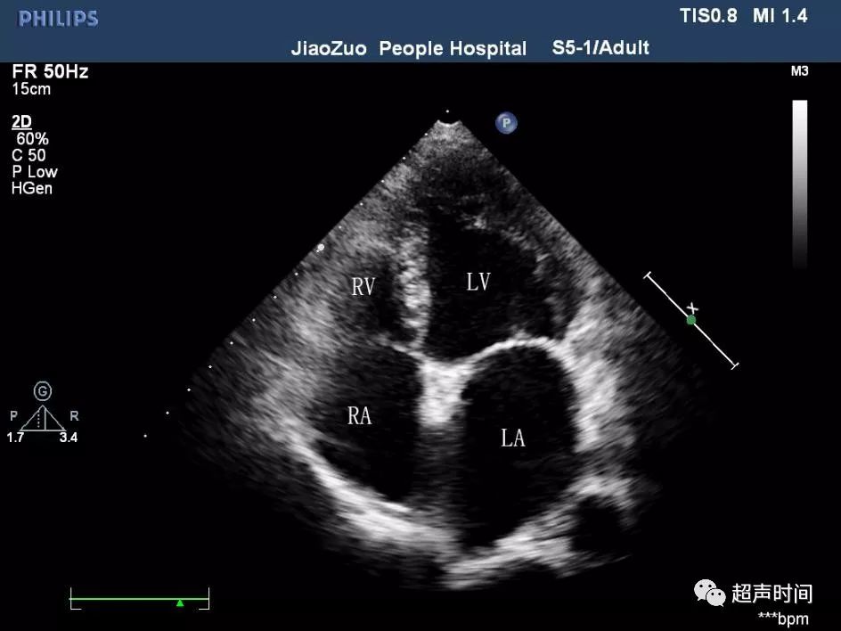 心尖四腔心切面显示左房增大