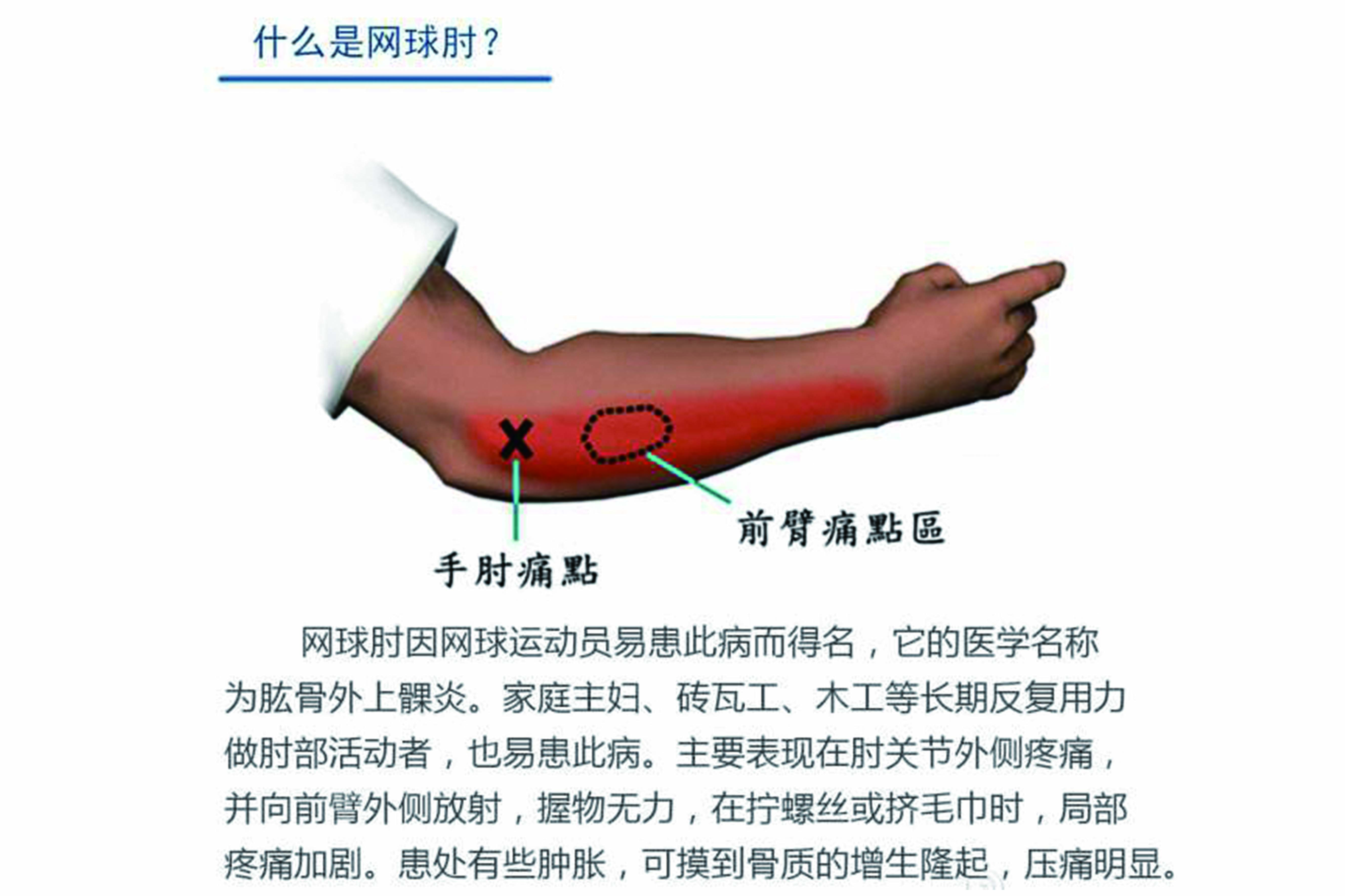 肱骨外上髁炎又称网球肘,网球肘多因前伸肌群因长期反复强烈的收缩