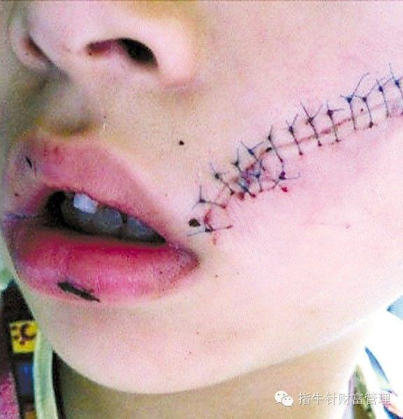                     花露水竟使7岁女童烧伤致残？！日常用品也可能造成大伤害，切莫掉以轻心！
