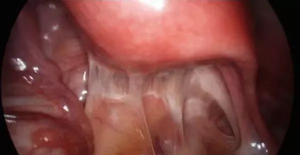 如何快速解决嗓子黏腻的感觉 e927264183274a7ab8a9331232589865.jpeg