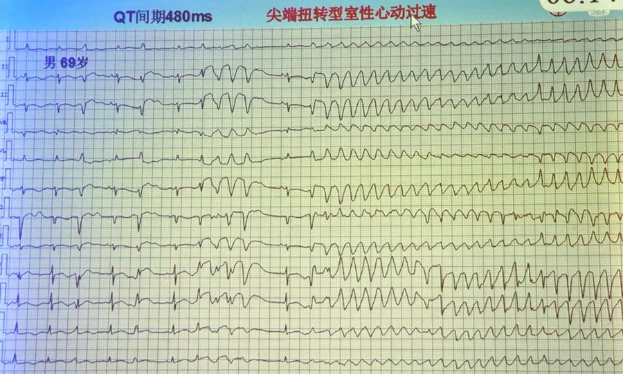 尖端扭转型室性心动过速,多形性室性心动过速,双向性室性心动过速.