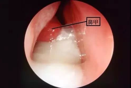 因为病毒和细菌导致了炎症,使鼻粘膜肿胀,充血,出现鼻塞,粘液流动