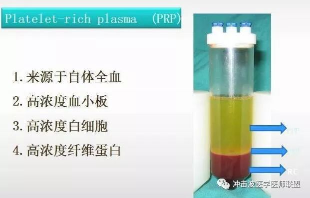 prp富血小板血浆治疗退化性膝关节炎