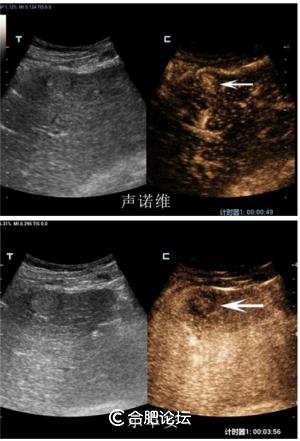 中科大附一院南区超声科在省内率先使用新型超声造影剂对一小肝癌患者