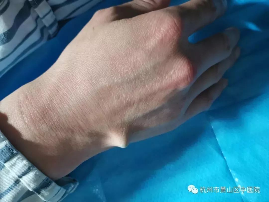 耍帅火遍抖音的筷子开啤酒瓶让手外科医生很纠心