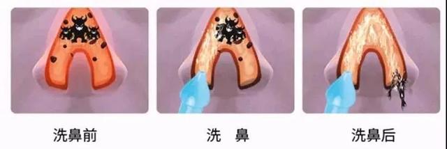                     孩子鼻炎鼻塞，这个方法比打针吃药还管用，快收藏吧