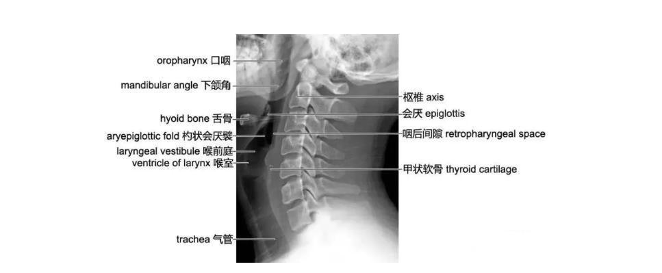 你得的是什么颈椎病