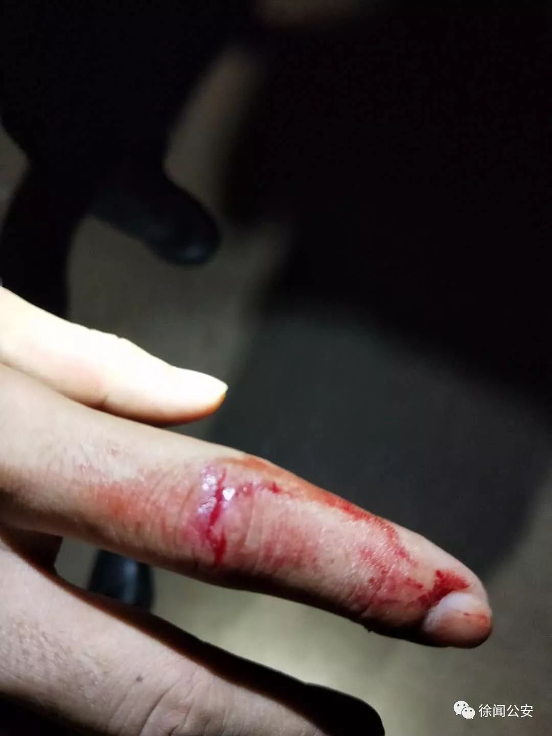 守守等队员在围追堵截,跟踪抓捕过程中及与飙车党搏斗时 不同程度受伤
