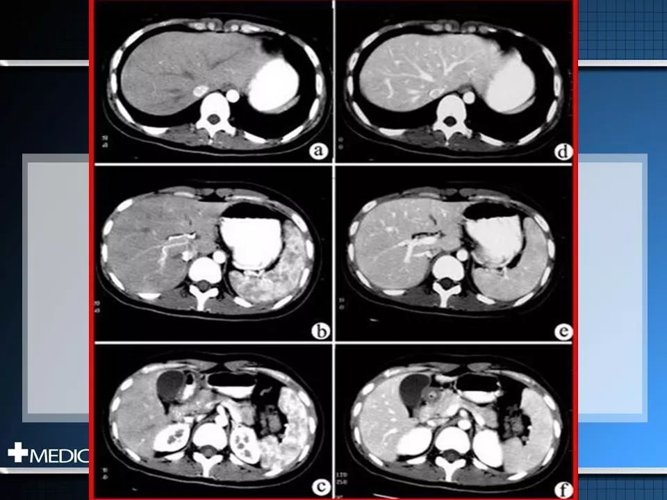 原发性肝癌的影像诊断 | 影像天地