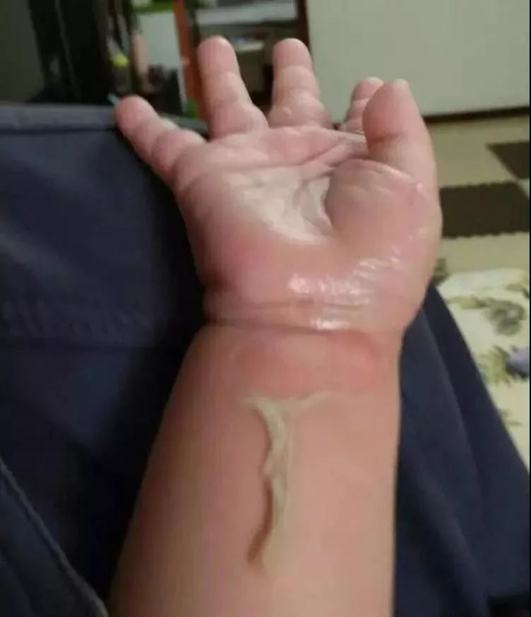 深圳一3岁女童烫伤后,因奶奶一顿操作被送院抢救!家长一定要注意!