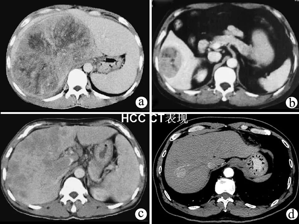 原发性肝癌的影像诊断 | 影像天地