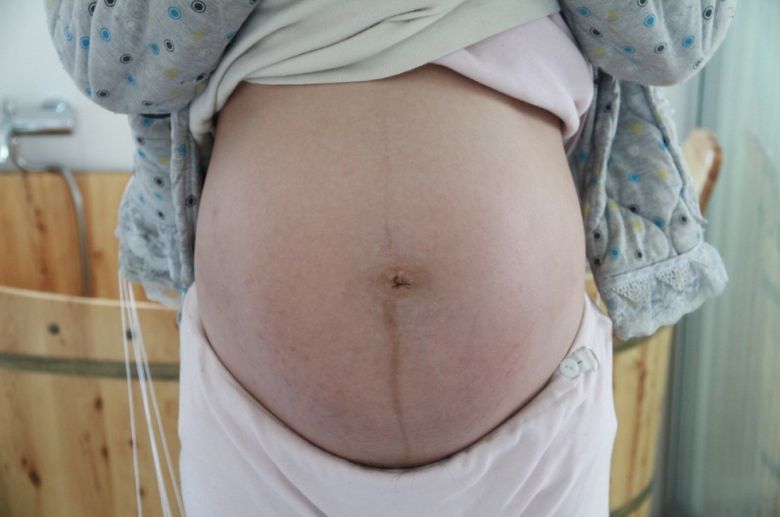 怀孕期间，孕妈若有3个感觉，可能马上“长妊娠纹”，不妨一看|孕妈在怀孕期间