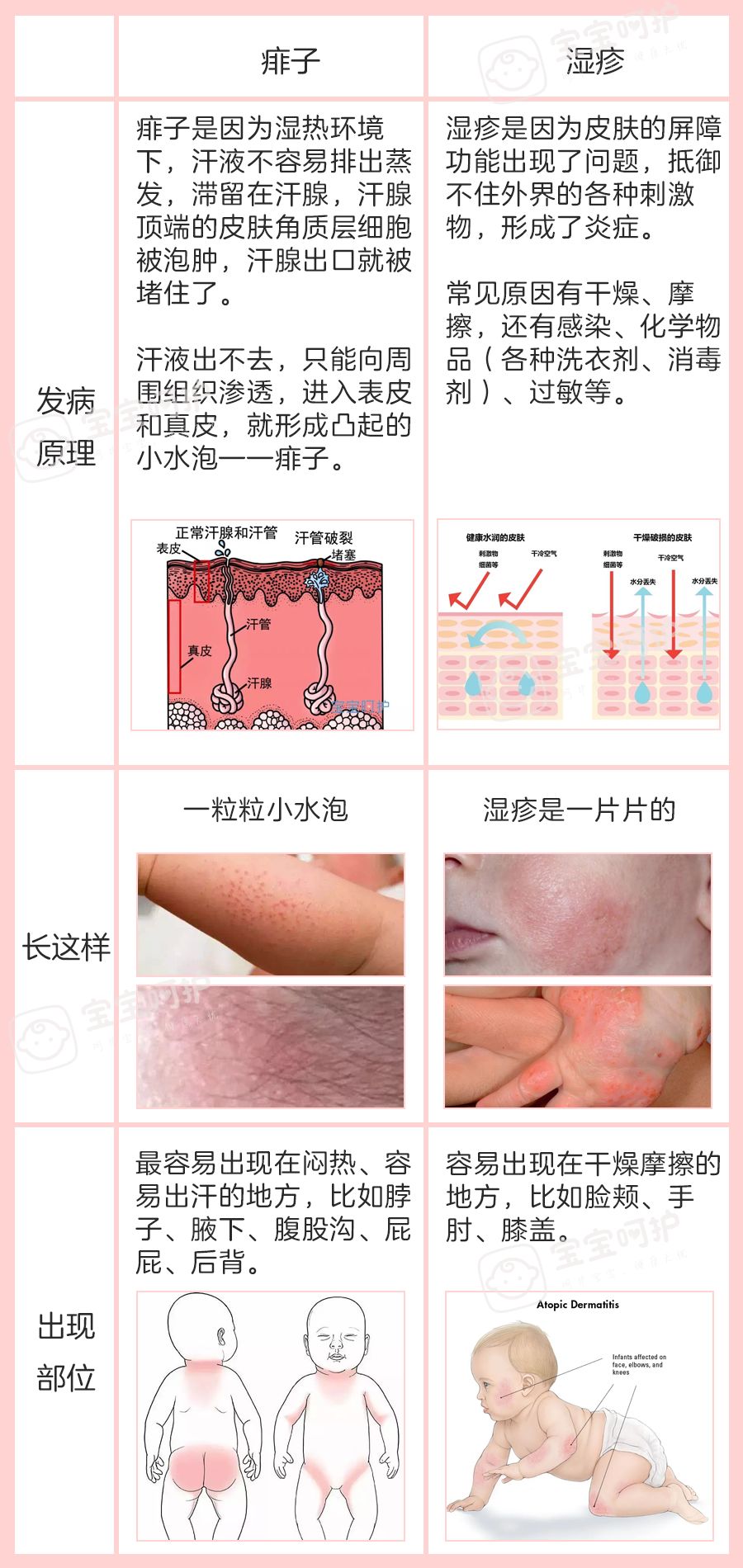                     这两种疹子家长总用错药，难怪孩子反复发作老不好