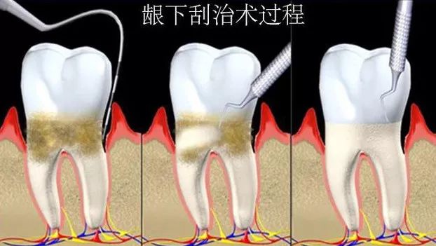 洁牙vs牙周治疗,到底有啥区别?