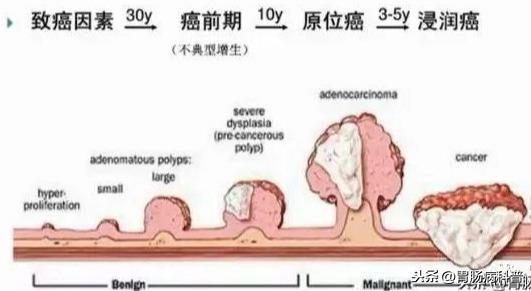 结肠息肉约10-30年演变为癌前病变,5-10年演变为癌症,后浸润,转移