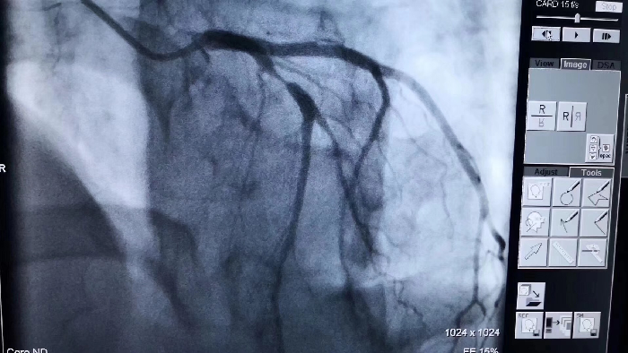 心血管一科成功实施一例生物可吸收支架置入术:心血管支架