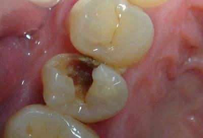 脱矿没有及时修复,牙齿表面开始缺损,就成为我们说的蛀牙,牙洞了.
