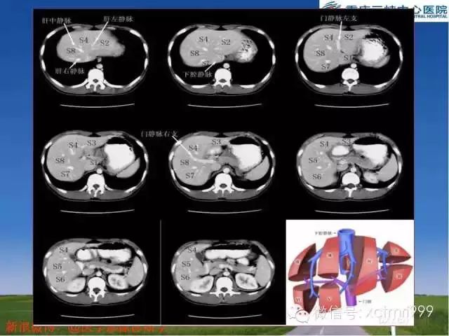影像解剖丨肝脏分段及其详细解读